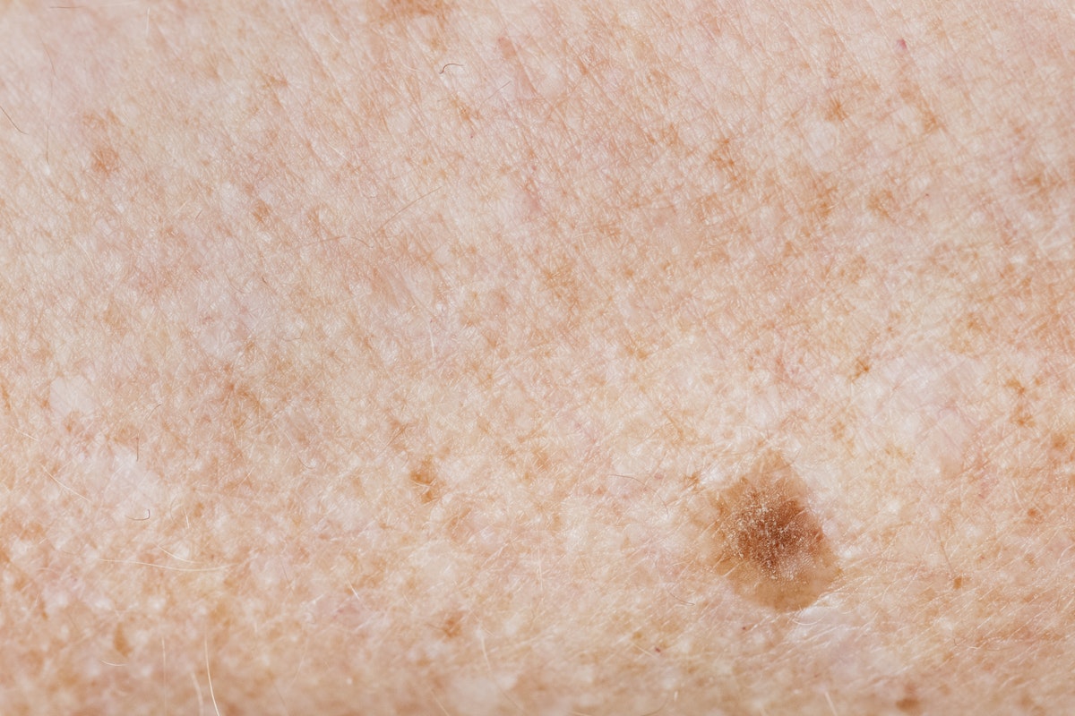 Freckled Skin Skin Cancer 